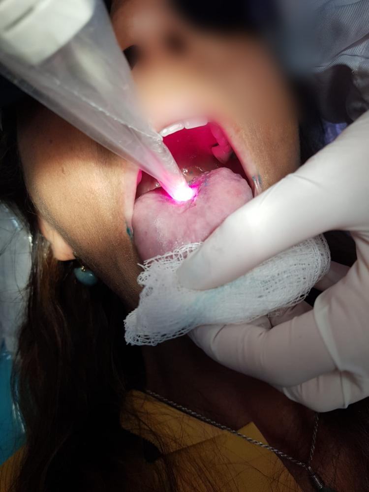 Laserterapia no tratamento da candidíase, ardência bucal e alteração de paladar