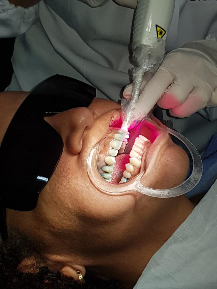 Terapia fotodinâmica na doença periodontal